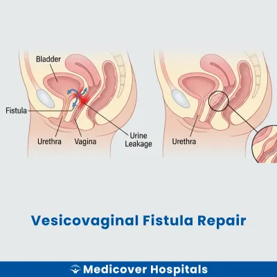 Vesicovaginal Fistula Repair