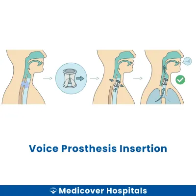 Voice Prosthesis Insertion