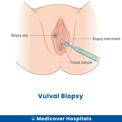 Vulval Biopsy
