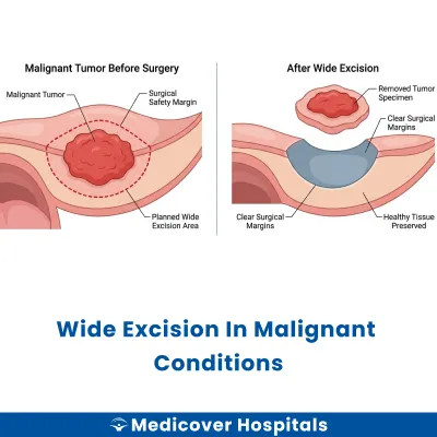 Wide Excision In Malignant Conditions