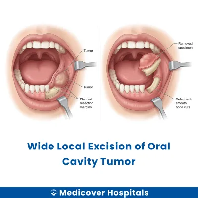 Wide Local Excision of Oral Cavity Tumor