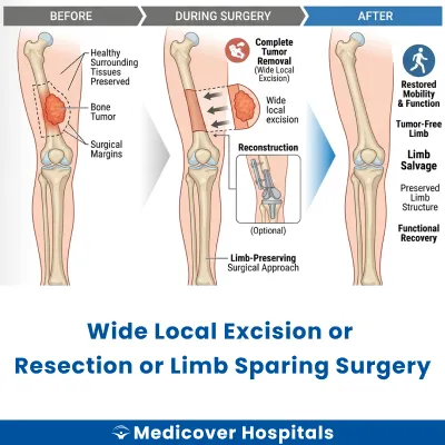 Wide Local Excision Or Resection Or Limb Sparing Surgery