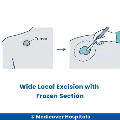 Wide Local Excision With Frozen Section