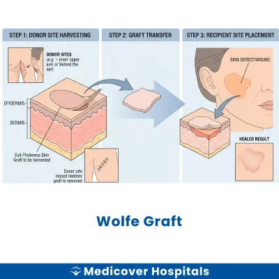 Wolfe Graft