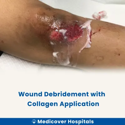 Wound Debridement With Collagen Application