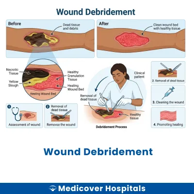 Wound Debridement