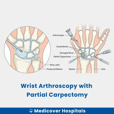 Wrist Arthroscopy With Partial Carpectomy