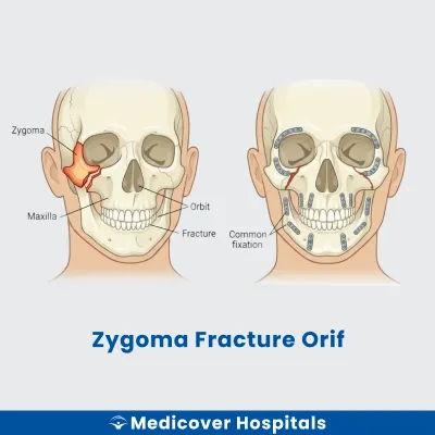 Zygoma Fracture Orif