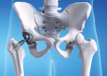 Revision Hip Surgery bone loss