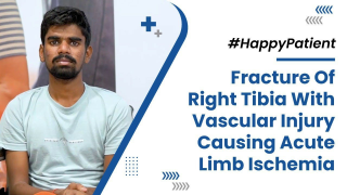 Fracture Of Right Tibia With Vascular Injury Causing Acute Limb Ischemia
