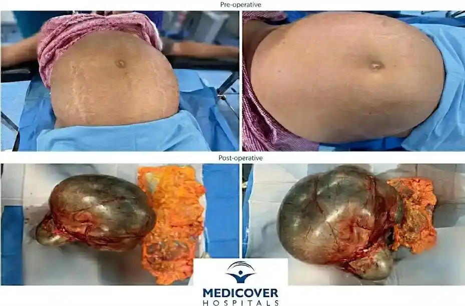 Abdominal Tumor-sensitive content contains blood