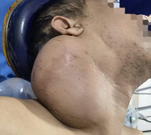 5kg Neck Tumor Removal Hyderabad 2