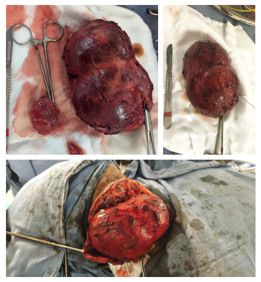 5kg Neck Tumor Removal Hyderabad sensitive content containes blood