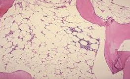 allogenic-bmt-first-time-in-ap-telangana-medicover-1