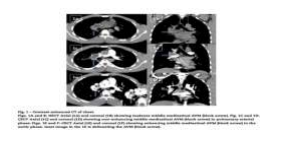arteriovenous-malformations-in-the-mediastinum-1