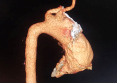 concomitant-bentall-operation-plus-aortic-arch-replacement-1