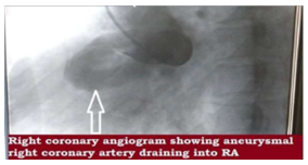coronary-artery-fistula-2