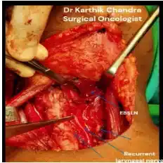 critical-structures-in-thyroidectomy