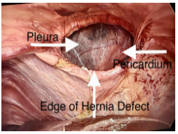 diaphragmatic-hernia-3