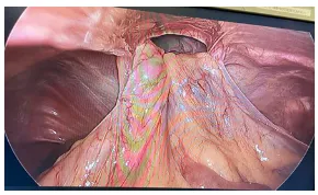 Diaphragmatic Hernia Defect