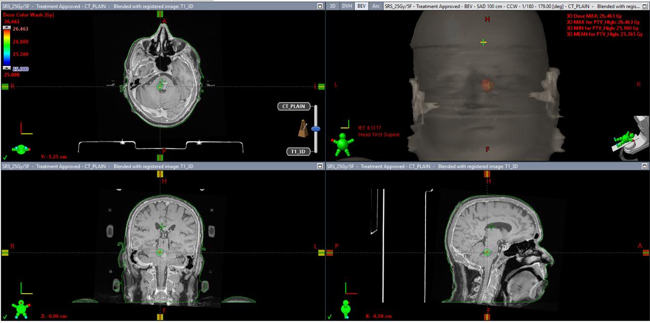 dose-volume-histogram-dvh-beams-eye-view-bev-for-srs-treatment