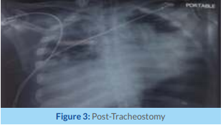 infarct-and-low-molecular-weight-heparin-3