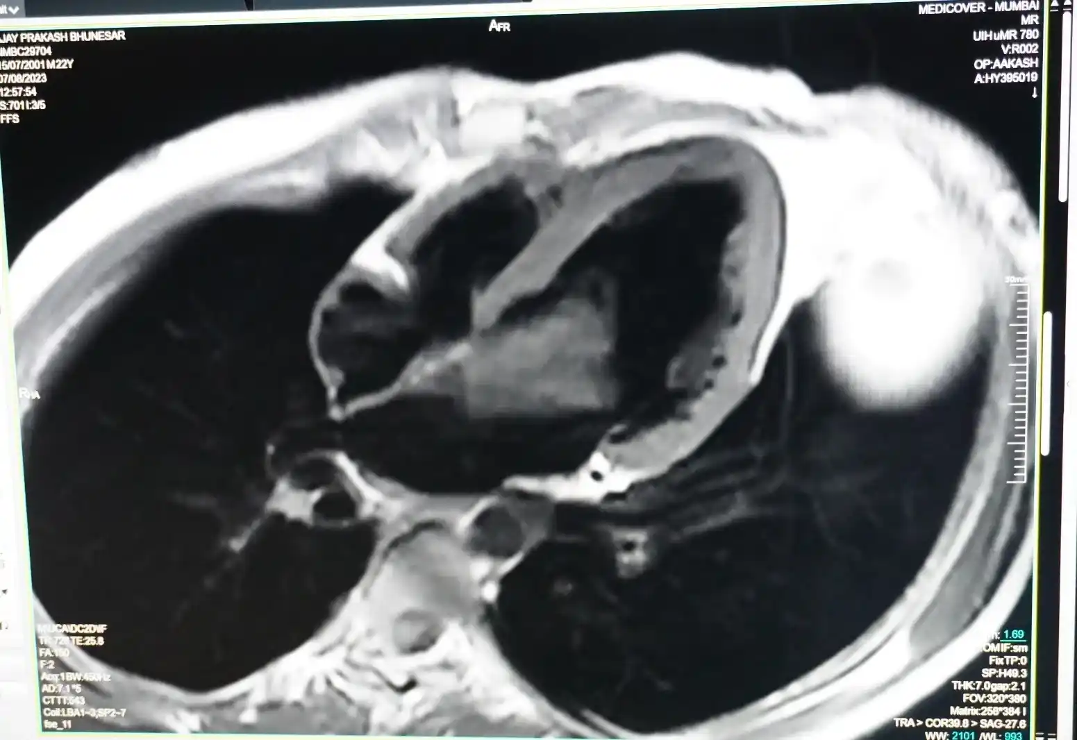 Large La Myxoma In Young Stroke Patient Treated Surgically