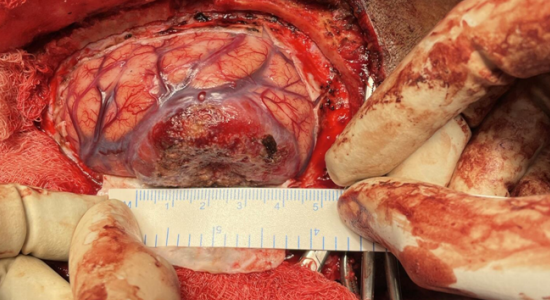 left-parietal-craniotomy-and-tumor-excision-3