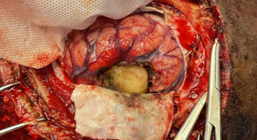 left-parietal-craniotomy-and-tumor-excision-4