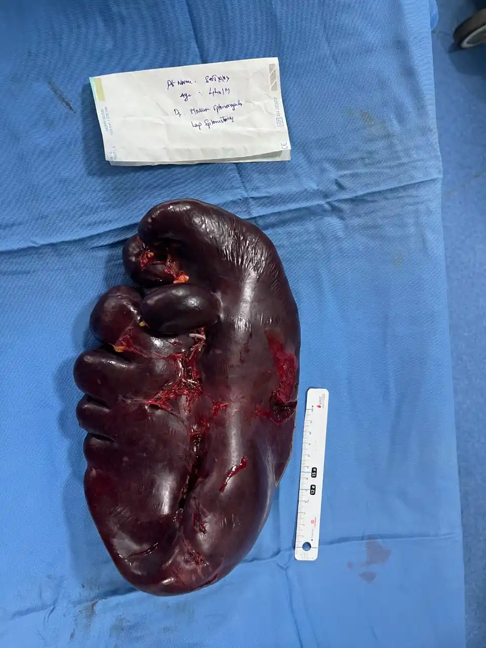 Enlarged spleen-sensitive content contains blood