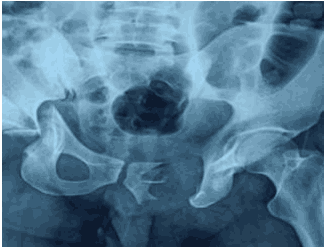 pelvic-acetabular-fracture-1