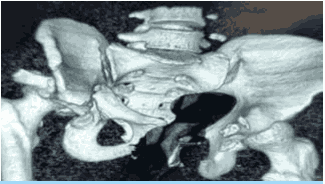 pelvic-acetabular-fracture-2