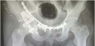 pelvic-acetabular-fracture-3