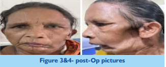 prevalence-of-second-primary-in-oral-cavity-2