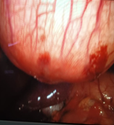 rare-occurrence-of-hydatid-cyst-over-abdominal-wall-2