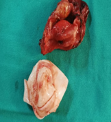 rare-occurrence-of-hydatid-cyst-over-abdominal-wall-3