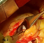 ruptured-sinus-of-valsalva-aneurysm-2