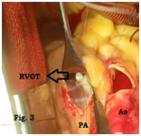 ruptured-sinus-of-valsalva-aneurysm-3