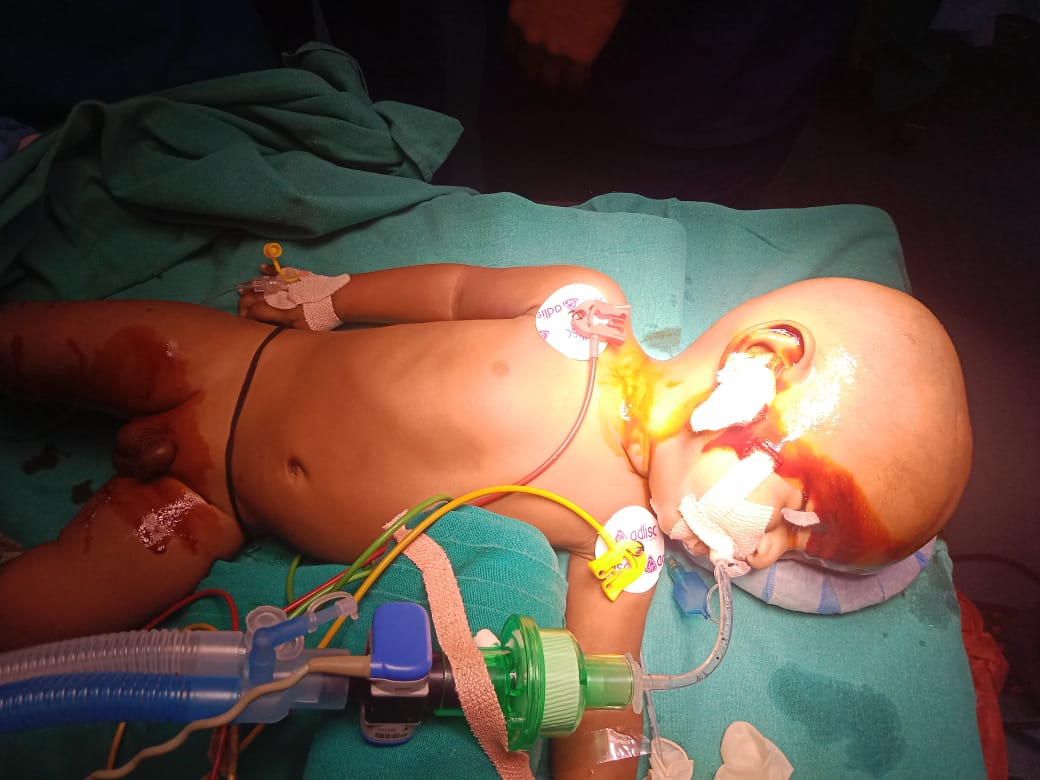 Craniotomy for Severe TBI with EDH and Laryngomalacia