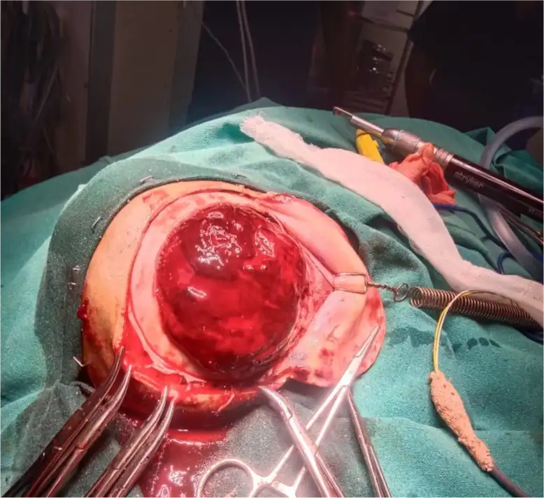 Craniotomy for Severe TBI with EDH and Laryngomalacia image