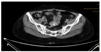 small-bowel-gastrointestinal-stromal-tumor02