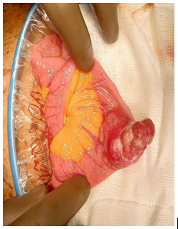 small-bowel-gastrointestinal-stromal-tumor03