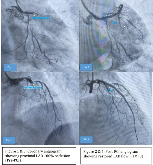 Saving Hemophilia Patient With Major Heart Attack 1