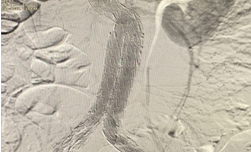 suture-less-endovascular-aneurysm-repair-for-abdominal-aortic-aneurysm-1