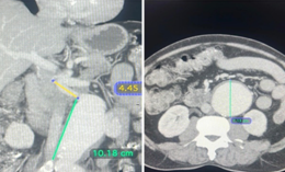 suture-less-endovascular-aneurysm-repair-for-abdominal-aortic-aneurysm-2