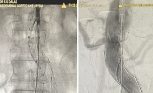 suture-less-endovascular-aneurysm-repair-for-abdominal-aortic-aneurysm-3