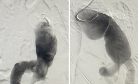 suture-less-endovascular-aneurysm-repair-for-abdominal-aortic-aneurysm-4