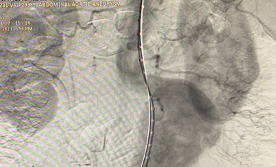 suture-less-endovascular-aneurysm-repair-for-abdominal-aortic-aneurysm-5
