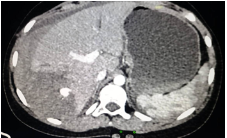 transarterial-embolization-of-pseudoaneurysm