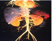 transarterial-embolization-of-pseudoaneurysm
